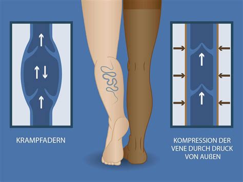 Schaumbehandlung von Krampfadern